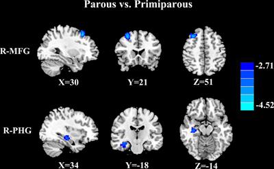 Decreased brain functional connectivity associated with cognitive dysfunction in women with second pregnancy